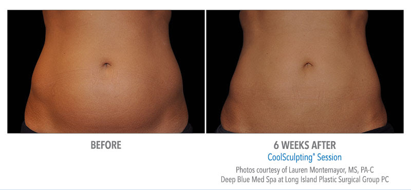 CoolSculpting® in Louisville, KY